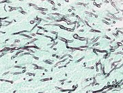 180px-Pulmonary_aspergillosis_%282%29_invasive_type.jpg