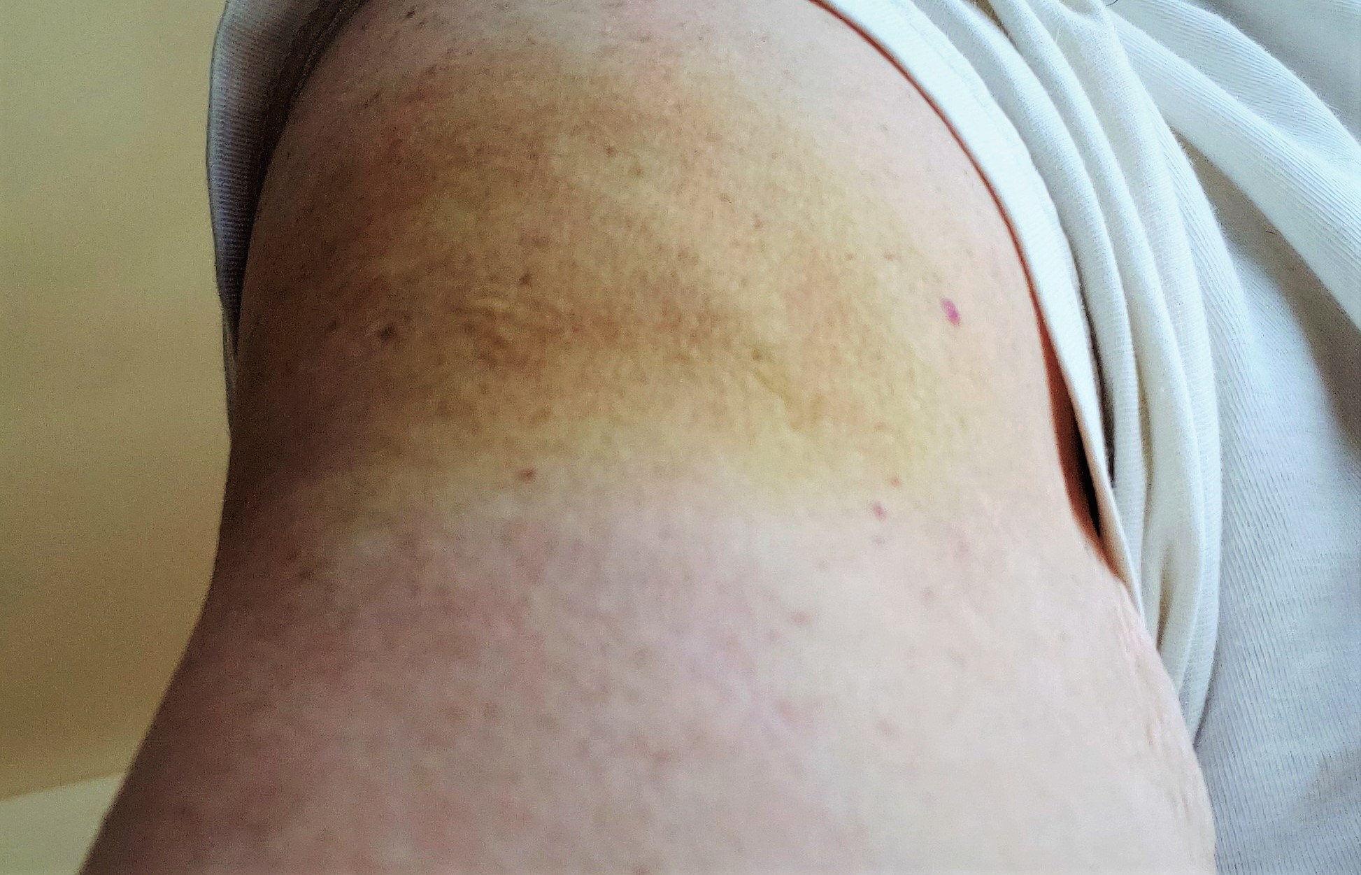 MyArm5Days.jpg